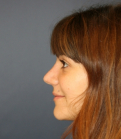 Feel Beautiful - Rhinoplasty 225 - After Photo